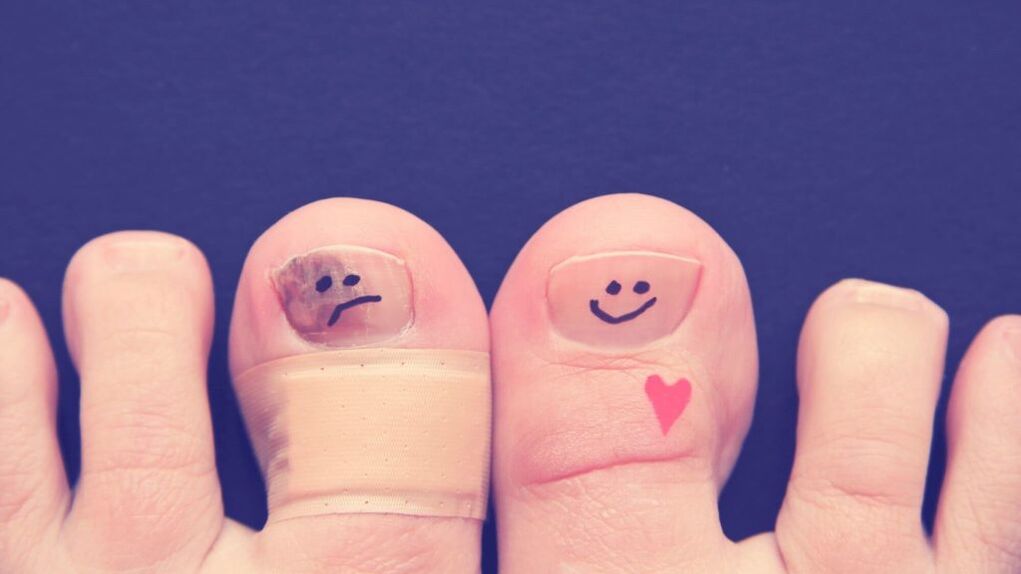 нокът с гъбички и здрав