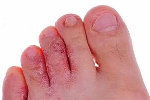 гъбички по пръстите на краката